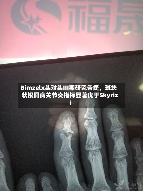 Bimzelx头对头III期研究告捷，斑块状银屑病关节炎指标显著优于Skyrizi