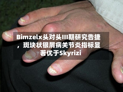 Bimzelx头对头III期研究告捷，斑块状银屑病关节炎指标显著优于Skyrizi-第2张图片